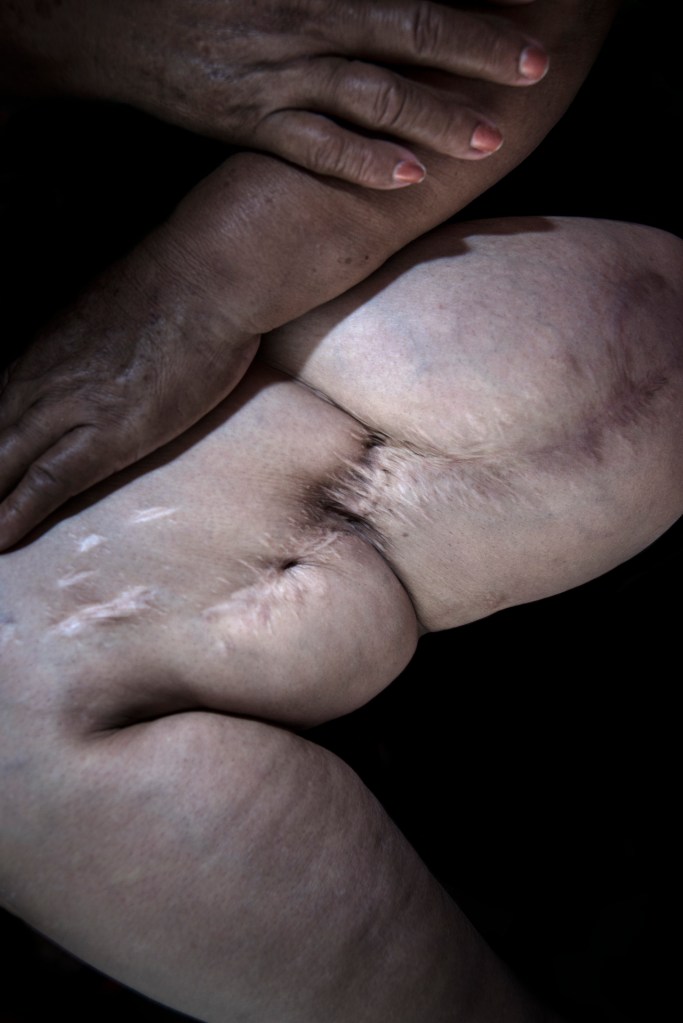 Koleszár Adél: Az erőszak sebei, részlet a sorozatból, 2017-2018